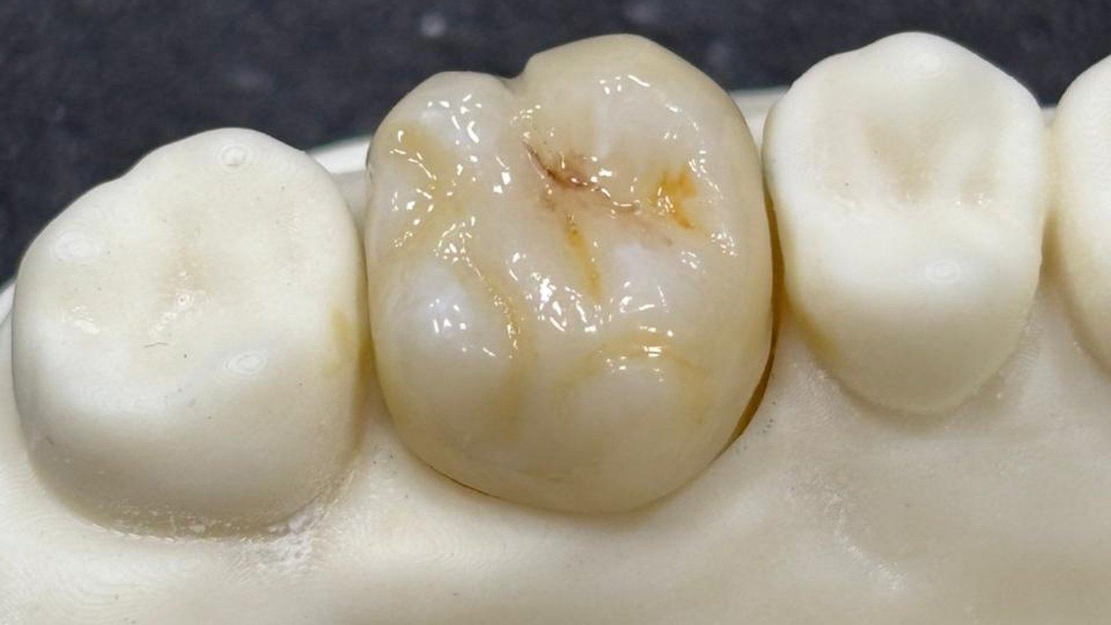 Dente posterior caracterizado por aluno orientado pelo mentor Jairo
