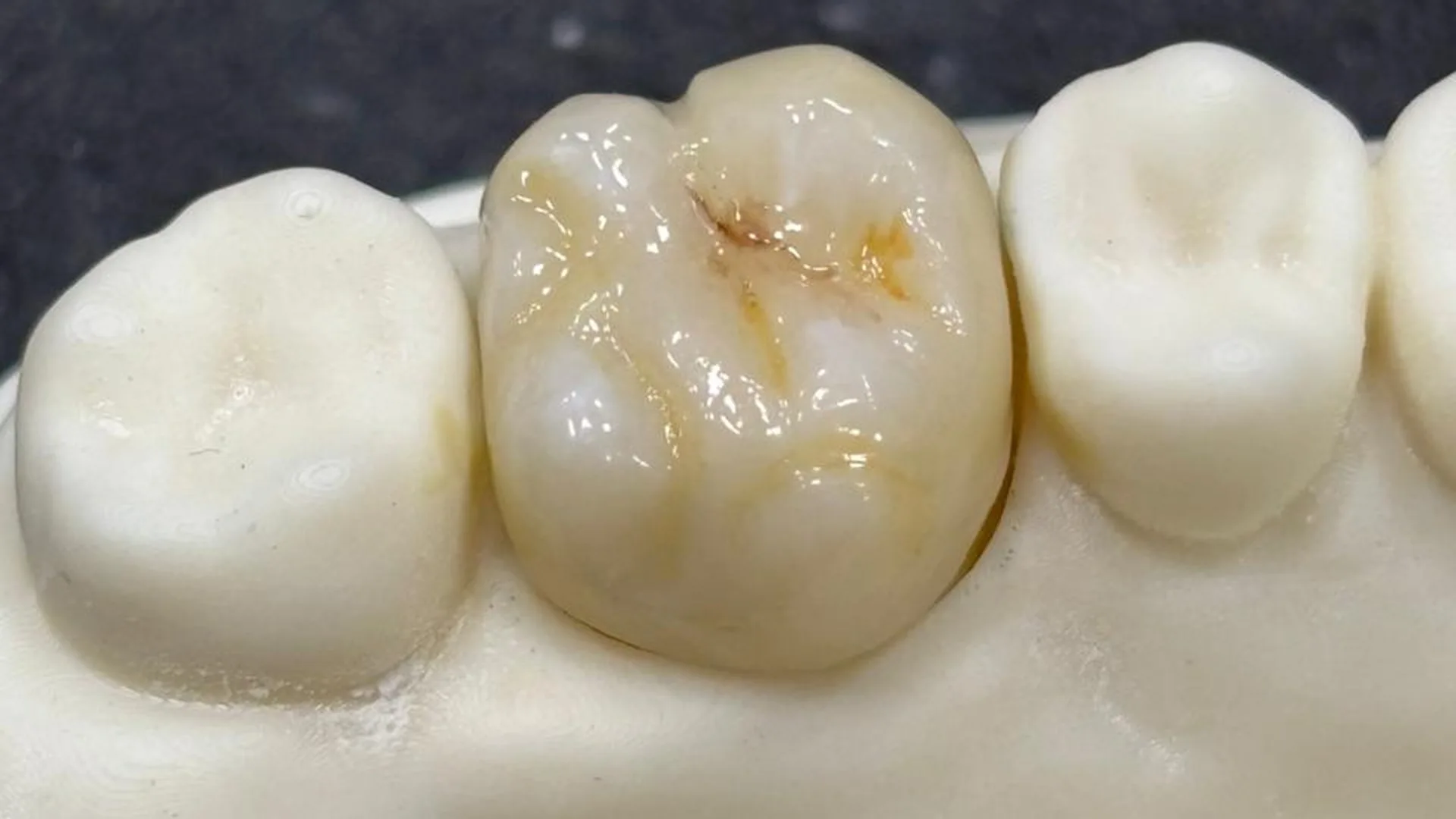 Dente posterior caracterizado por aluno orientado pelo mentor Jairo