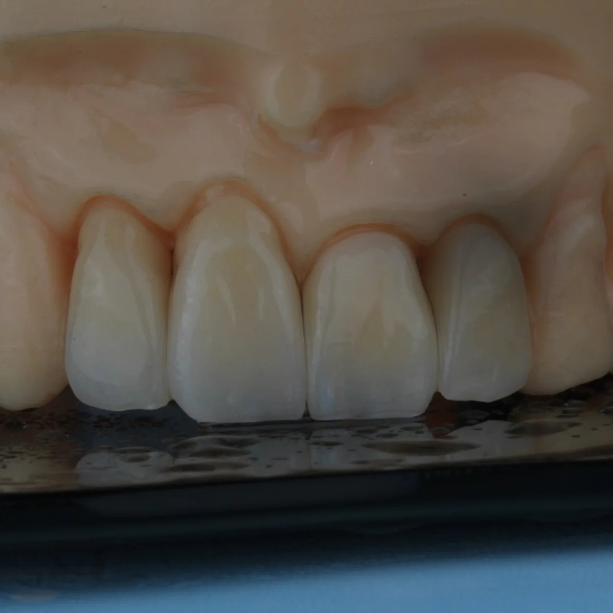Coroas e facetas anteriores em dissilicato de lítio