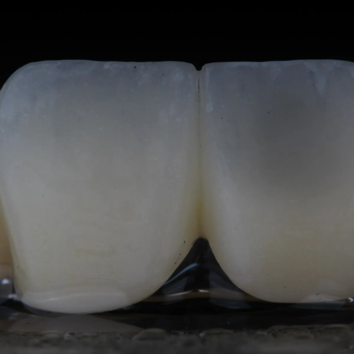 Faceta estética anterior em cerâmica