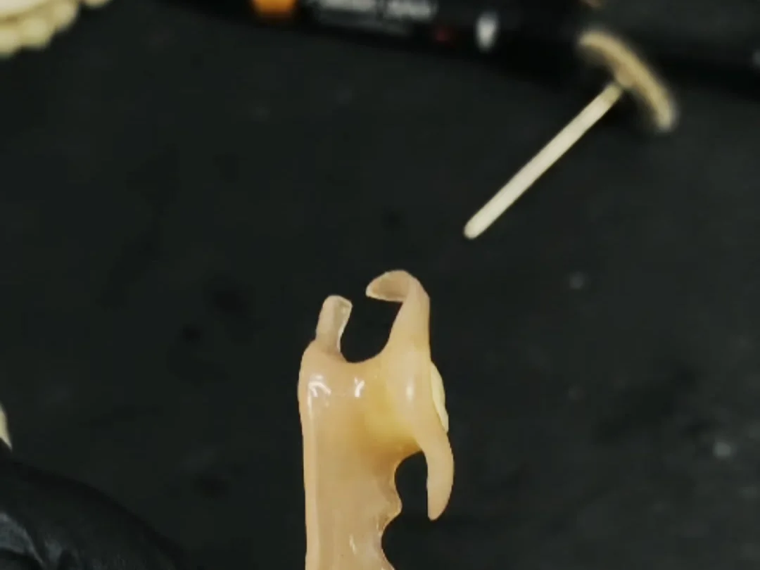 Detalhe do grampo da prótese parcial flexível, feito no mesmo material da base, sem metal
